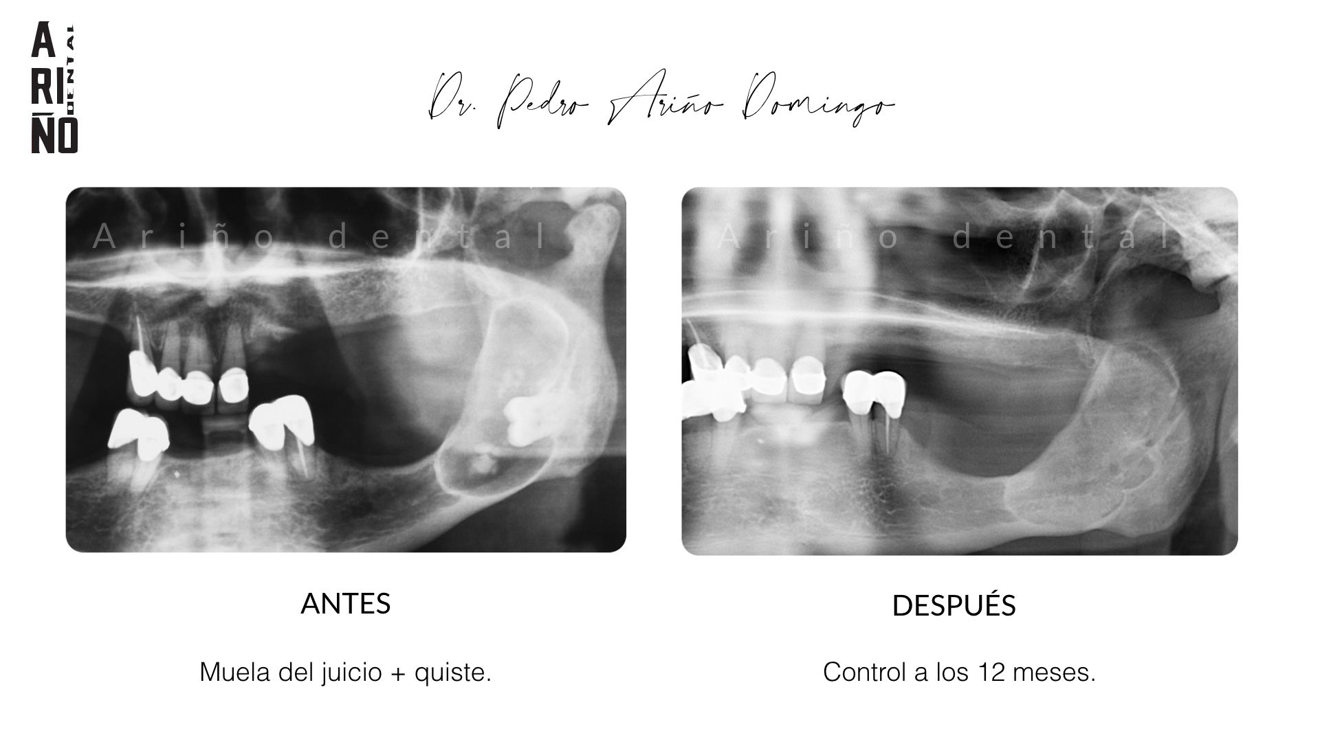 Casos Cl Nicos Periodoncista Madrid Ari O Dental